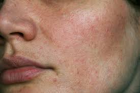 Micropen® elite can be used on all parts of the body, including the: What Causes Uneven Skin Texture Body Shaping Clinic Revive Life Treatment Center Of South Jersey