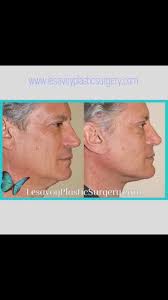 Malcolm Lesavoy (@lesavoyplasticsurgery) • Instagram-Fotos und -Videos