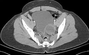 They are important in planning for certain types of therapy and surgery, as well as in the aftermath to determine whether the patient's body is responding to treatment. Computed Tomography Imaging Of The Acute Pelvis In Females Sciencedirect