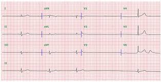 Sick Sinus Syndrome Amboss