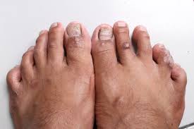 Image result for black toe diabetes