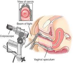 Colposcopy Colposcopy Biopsy Results Hpv Side Effects