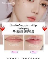 ✨Needle-free stem cell sexy doodle lip #无针性感嘟嘟唇👄 ❌needle ❌Botox/ filler  ❌side effect ☑️natural & safe 无针无敷麻药无手术几乎零痛感取代botox /filler