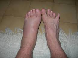 C'est une blessure extrêmement courante et une des premières causes de consultation aux urgences en france. Heuuuuu C Est Quoi Ca Broly Forever