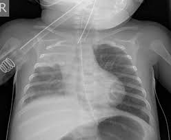 Image result for Air Bronchogram