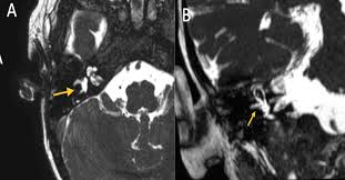 Image result for Bacterial Labyrinthitis