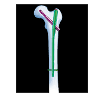 PFNA Proximal Femoral Nail Antirotation,Spiral Blade With ...