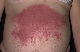 Image result for Rhus Dermatitis