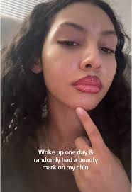 Chin Beauty Marks