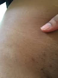 Ingrown hair removed from pubic area, so painful! Tmi Vagina Pic Help With Ingrown Hair Marks Glow Community