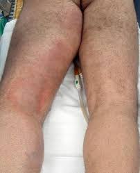 This page focuses on type ii necrotizing fasciitis where streptococcus pyogenes is isolated alone or in combination with another species. Recent Advances In The Treatment Of Necrotizing Fasciitis Springerlink