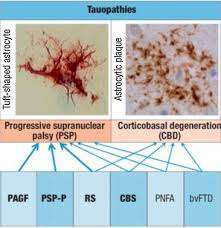 Progressive Supranuclear Palsy And Corticobasal Degeneration Diagnostic Challenges And Clinicopathological Considerations Sciencedirect