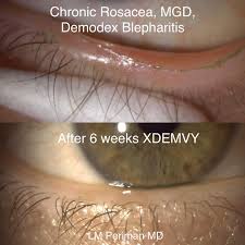 Image result for demodex rosacea