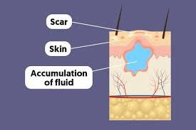However, he is still able to eat and drink. Seroma What Is It Symptoms Causes Treatment Tua Saude