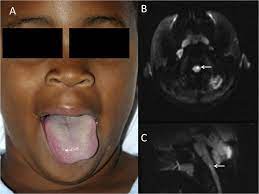 Wrong Side Tongue Deviation In Hemiplegia From Stroke Pediatric Neurology