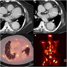 People who have cancer or a precancerous conditions are more likely to have ct scans. Usefulness Of Staging Chest Ct In Patients With Operable Breast Cancer