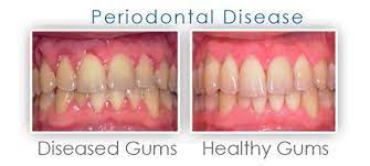 Dentaltown Where The Dental Community Lives Bleeding Gum Periodontal Disease Gum Disease