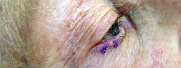 Hearing the doctor tell you that you've got cancer is undoubtedly one of the worst things you may experience. What Do Eyes Have To Do With It Dr Maral Skelsey