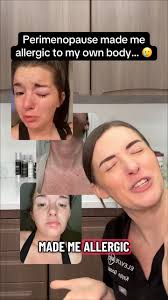 If you’re in #perimenopause & you’ve suddenly started experiencing all  sorts of weird histamine related symptoms… THIS VIDEO IS FOR YOU! 🫵🏻,  Histamine intolerance is a common issue for a lot of women ...