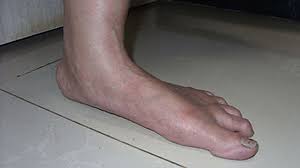 The most common cause of midfoot pain is a midtarsal joint sprain. Pictures Of Rheumatoid Arthritis Symptoms