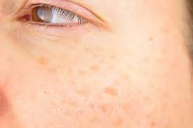 Are there any home remedies for sunspots on face? 7 Best Ways To Get Rid Of Age Spots Top Removers For Dark Spots