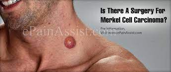 Your doctor will examine your skin for unusual moles, freckles, pigmented spots and other growths. Is There A Surgery For Merkel Cell Carcinoma