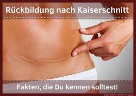 Ruckbildung Nach Kaiserschnitt Fakten Die Du Kennen Solltest Geburtsvorbereitung Ruckbildung Online