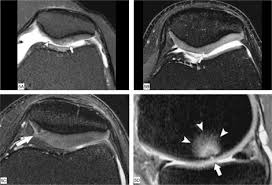 Interval up to arthroscopy justiﬁed this ﬁnding. Mri Evaluation Of Knee Cartilage Sciencedirect