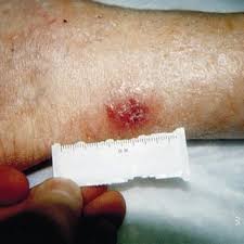 Check spelling or type a new query. Pdf Martorell S Hypertensive Leg Ulcer Case Report And Concise Review Of The Literature
