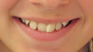 Vorher Nachher Kinder Kieferorthopadie Dr Bianca Mertens Lippstadt