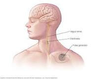 Image result for vagus nerve stimulator is a treatment in which a pulse generator is placed