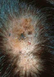 Final pathology showed malignant melanoma—spindle cell / desmoplastic type. Melanoma