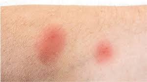 Image result for flea bites