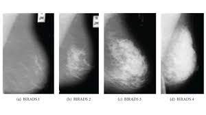 Accuracy of mammograms mammography is good at finding breast cancer, especially in women ages 50 and older. Mammogram Images Understanding Your Results