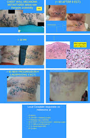 When cancerous tumors form on connective tissues, it is a sarcoma. Diagnosis And Treatment Of In Transit Melanoma Metastases Sciencedirect