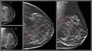 Based on mammograms taken from two angles, a computerized map shows the precise location of masses or calcifications. A Big Step For Breast Health In Texas 3 D Mammograms Now Covered By Insurance Cancer Ut Southwestern Medical Center