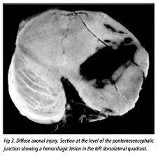 The Conformation Of The Brain Plays An Important Role In The Distribution Of Diffuse Axonal Injury In Fatal Road Traffic Accident