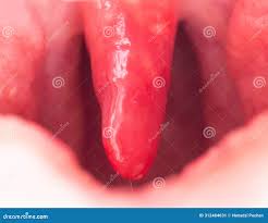 Image result for Uvulitis