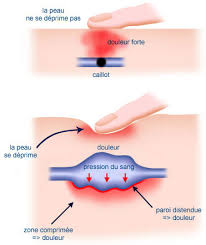 Douleurs au niveau jambes, et en particulier sur le trajet d'une veine, constatée lors d'immobilisation prolongée. Varice Definitions Formation Evolution Symptomes Diagnostic