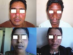 NASZA DERMATOLOGIAOnline OUR DERMATOLOGYOnline