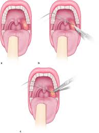 Image result for Peritonsillar Abscess