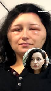 This girl’s head grew twice as big, all because of a terrible allergic  reaction.