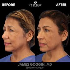 Can you believe this transformation came from a brow lift and eyelid  surgery? 👀 This beautiful patient underwent a brow lift and upper  blepharoplasty to address her concerns about heavy brows and