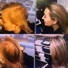 Hair growth centre | 23 followers on linkedin. The Hair Loss Centre Trichologist Twitter