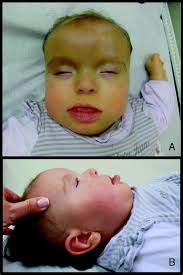Primary sports education are a coaching company based in dorset which provides sports coaching for boys and. Cytogenomic Delineation And Clinical Follow Up Of 10 Brazilian Patients With Pallister Killian Syndrome Molecular Cytogenetics Full Text