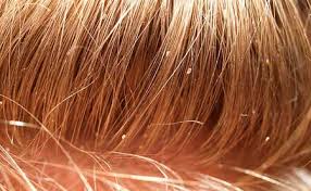 Get the hair wet and use a conditioner to ease the process. How To Get Rid Of Lice Best Proven Ways And Products In 2021