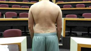 The medical evaluation for scoliosis includes learning about the patient's activities of daily living and how their scoliosis symptoms affect their quality of life is another important part of assessment, notes dr. How To Perform A Self Examination For Scoliosis The Spine Center