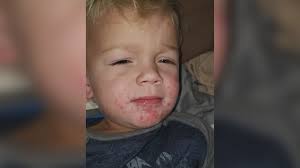 'I saw four or five with it:' Central Georgia cases of hand, foot, and  mouth disease