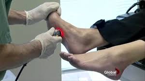 Foot Pain Laser Treatment Toronto Ontario Podiatrist Sheldon Nadal Dpm Youtube