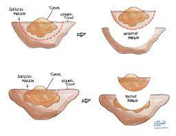 Errors in the instructions can cause the cell to stop its normal function and may allow a cell to become cancerous. Margin Pathology Dictionary Mypathologyreport Ca